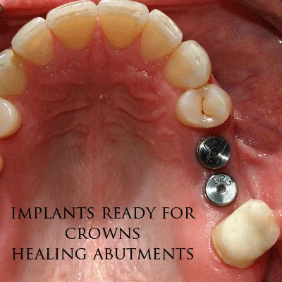 Dental Bridges: Types, Cost, and How They Compare to Implants